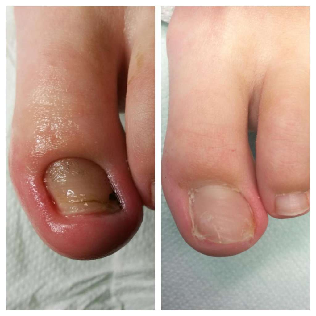 wkręcający paznokieć przed i po