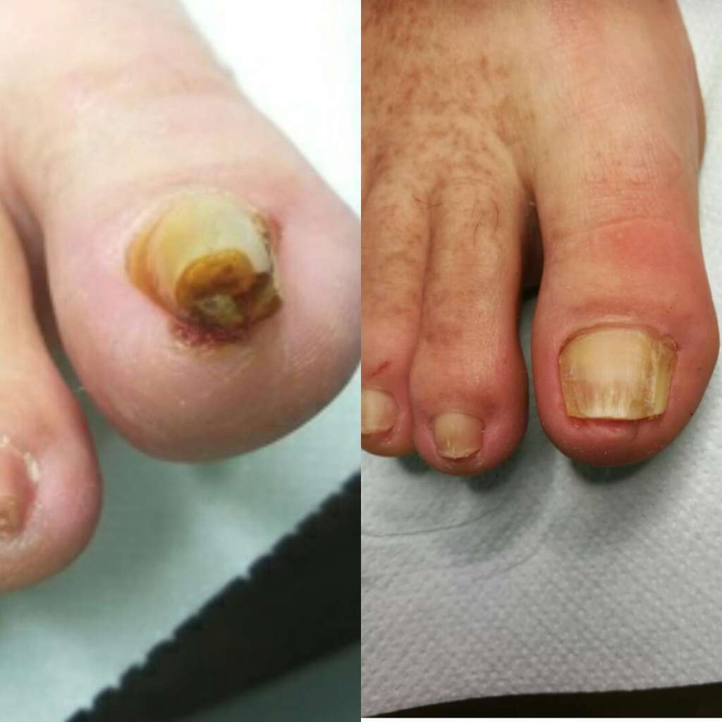 nieleczony wkręcający paznokieć kontra paznokieć po leczeniu