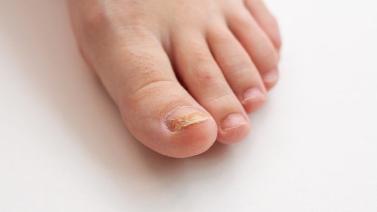 Jak zdiagnozować grzybicę paznokcia?