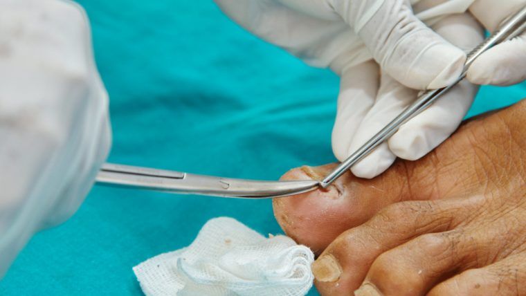 Dlaczego wrastających paznokci nie należy wycinać chirurgicznie?