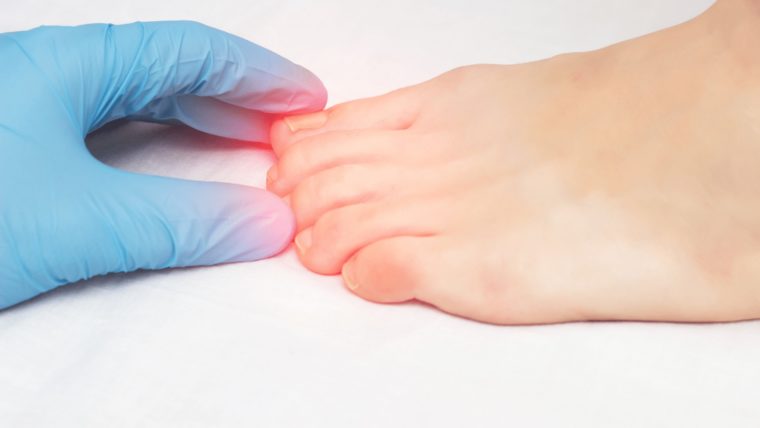 Jak zapobiegać wrastaniu paznokcia? Jak prawidłowo przycinać jego płytkę?