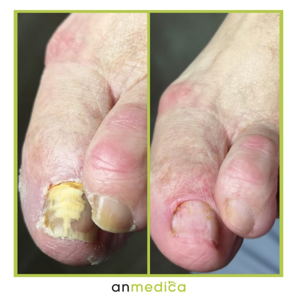 grzybica stóp i paznokci przed i po leczenie
