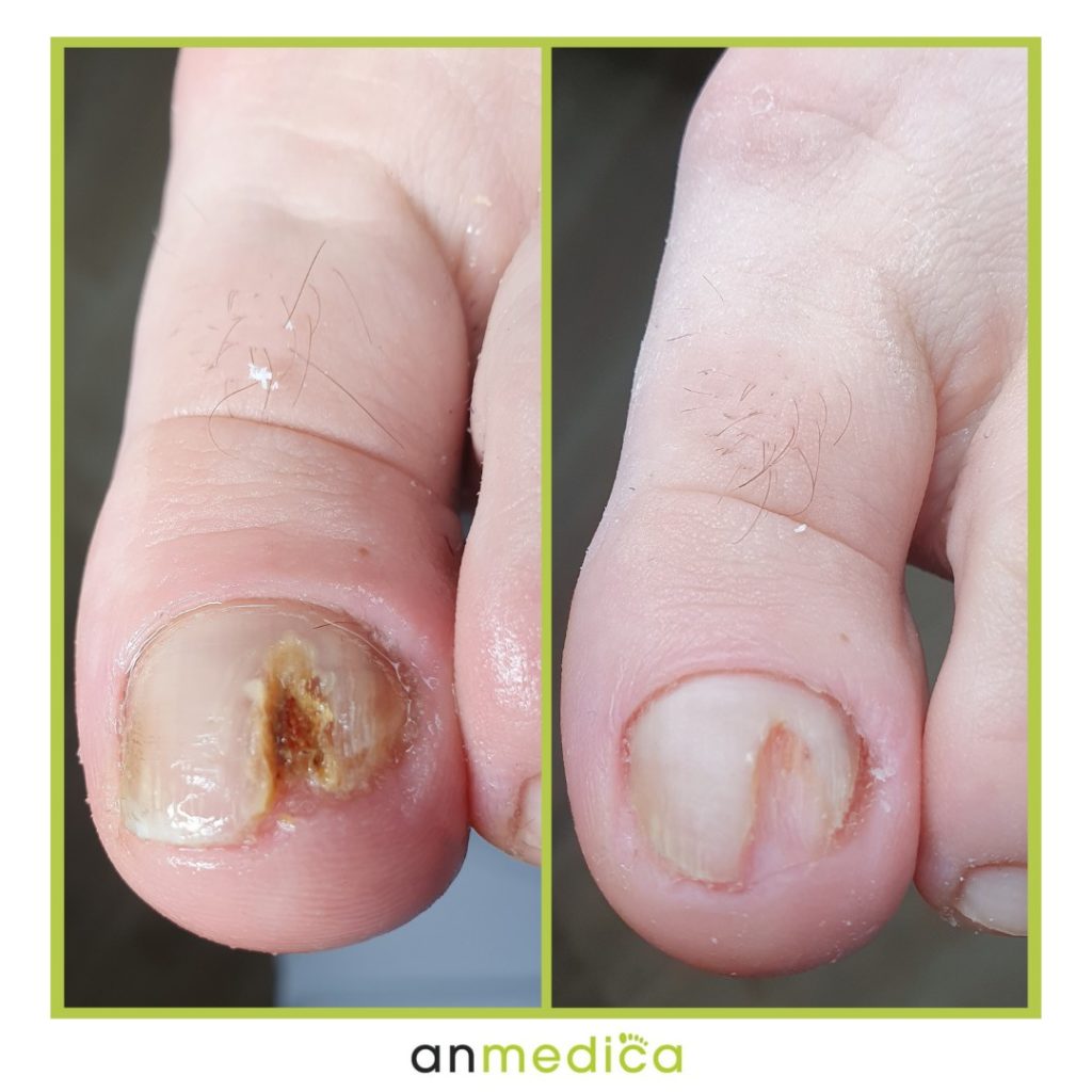 grzybica stóp i paznokci przed i po