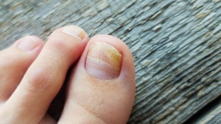 Jak długo trwa leczenie grzybicy paznokci? Co zrobić, aby zapobiec nawrotowi?