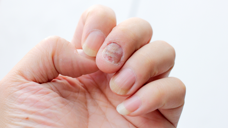 Drożdżyca paznokci - poznaj objawy, przyczyny, diagnostykę i metody leczenia