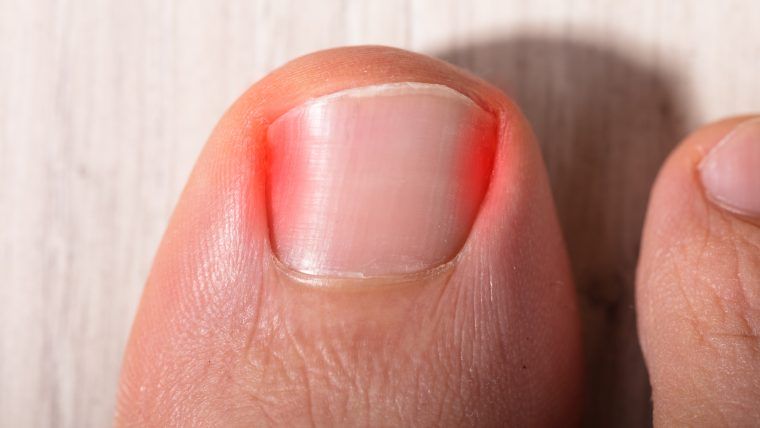 Ból palca stopy – poznaj przyczyny i metody leczenia