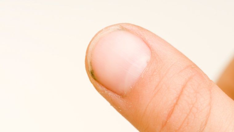 Uszkodzona macierz paznokcia - przyczyny i objawy. Jak leczyć uszkodzoną macierz paznokcia?