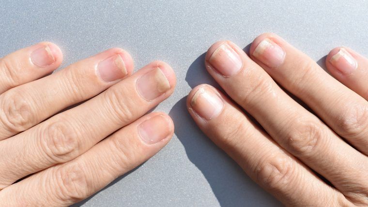 Onycholiza paznokci - przyczyny, objawy i leczenie onycholizy