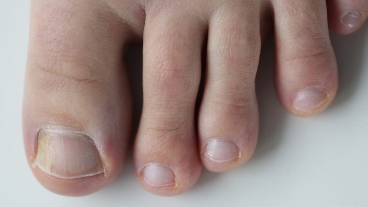 Onycholiza a grzybica paznokci - sprawdź różnicę