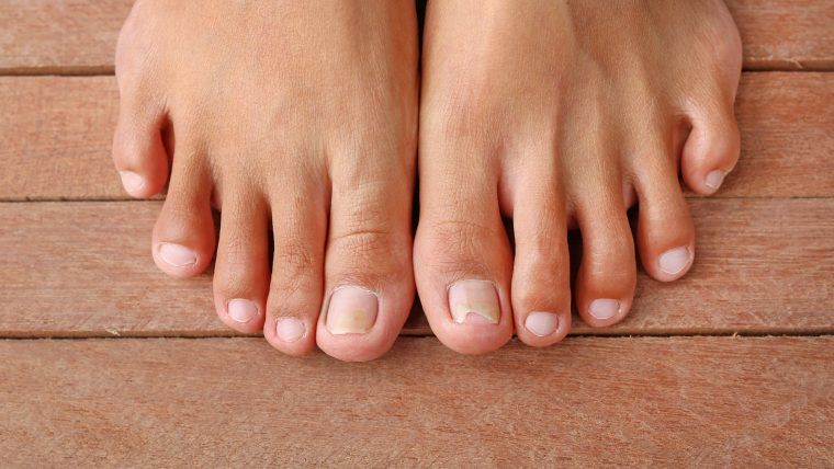 Łamliwe paznokcie - poznaj sposób na kruche paznokcie