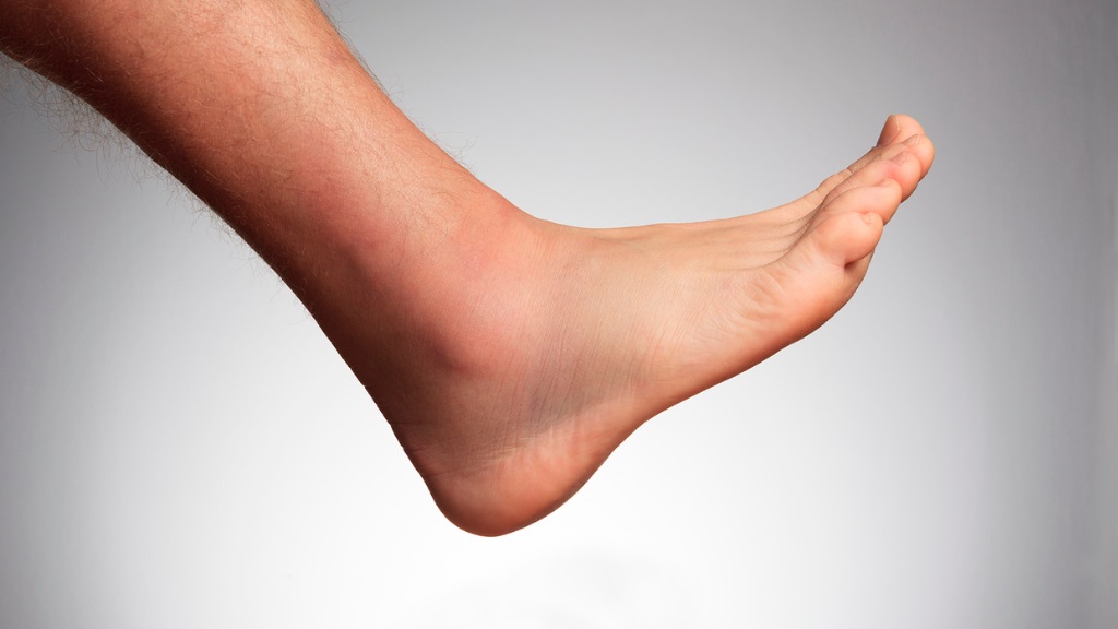leczenie stopy Charcota